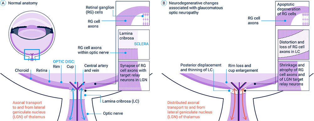 glaucomatous-optic-neuropathy-a-b-1_v2