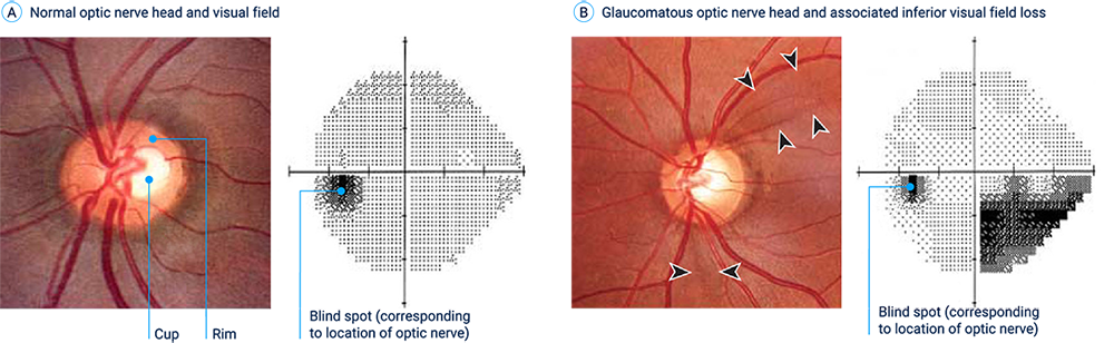 glaucomatous-optic-neuropathy-a-b-1_v2